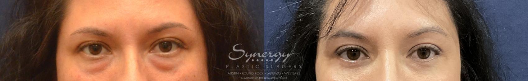 Before & After  Case 820 Front View in Austin, TX