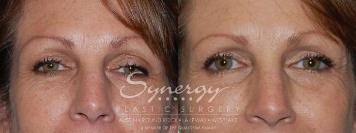 Before & After Eyelid Surgery (Blepharoplasty) Case 87 View #1 View in Austin, TX