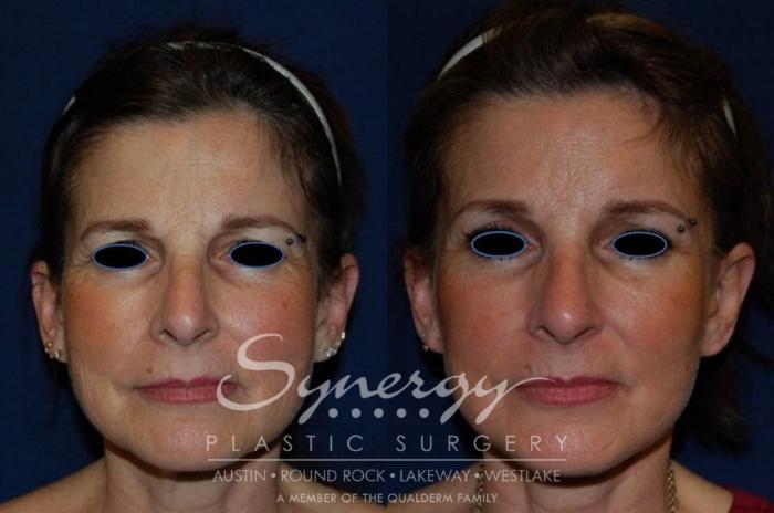 Before & After Facelift Case 123 View #2 View in Austin, TX
