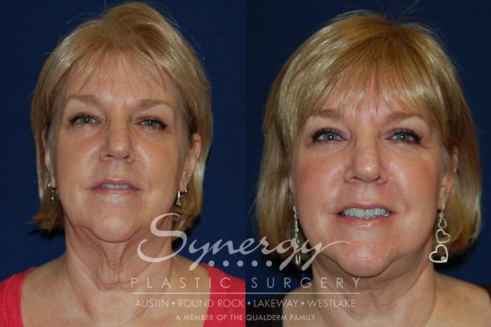 Before & After  Case 128 View #4 View in Austin, TX