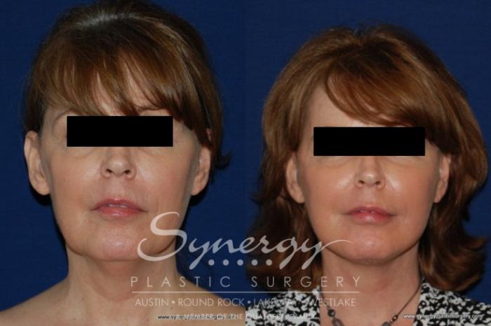 Before & After  Case 177 View #2 View in Austin, TX