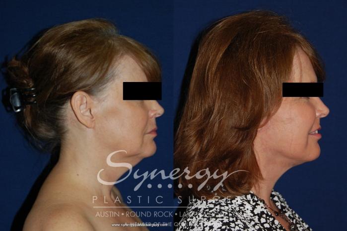 Before & After  Case 177 View #3 View in Austin, TX