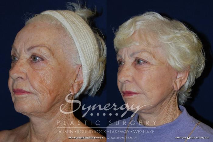 Before & After  Case 199 View #1 View in Austin, TX