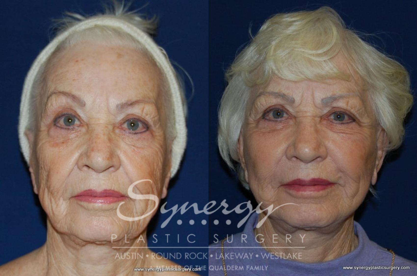 Before & After Facelift Case 199 View #2 View in Austin, TX