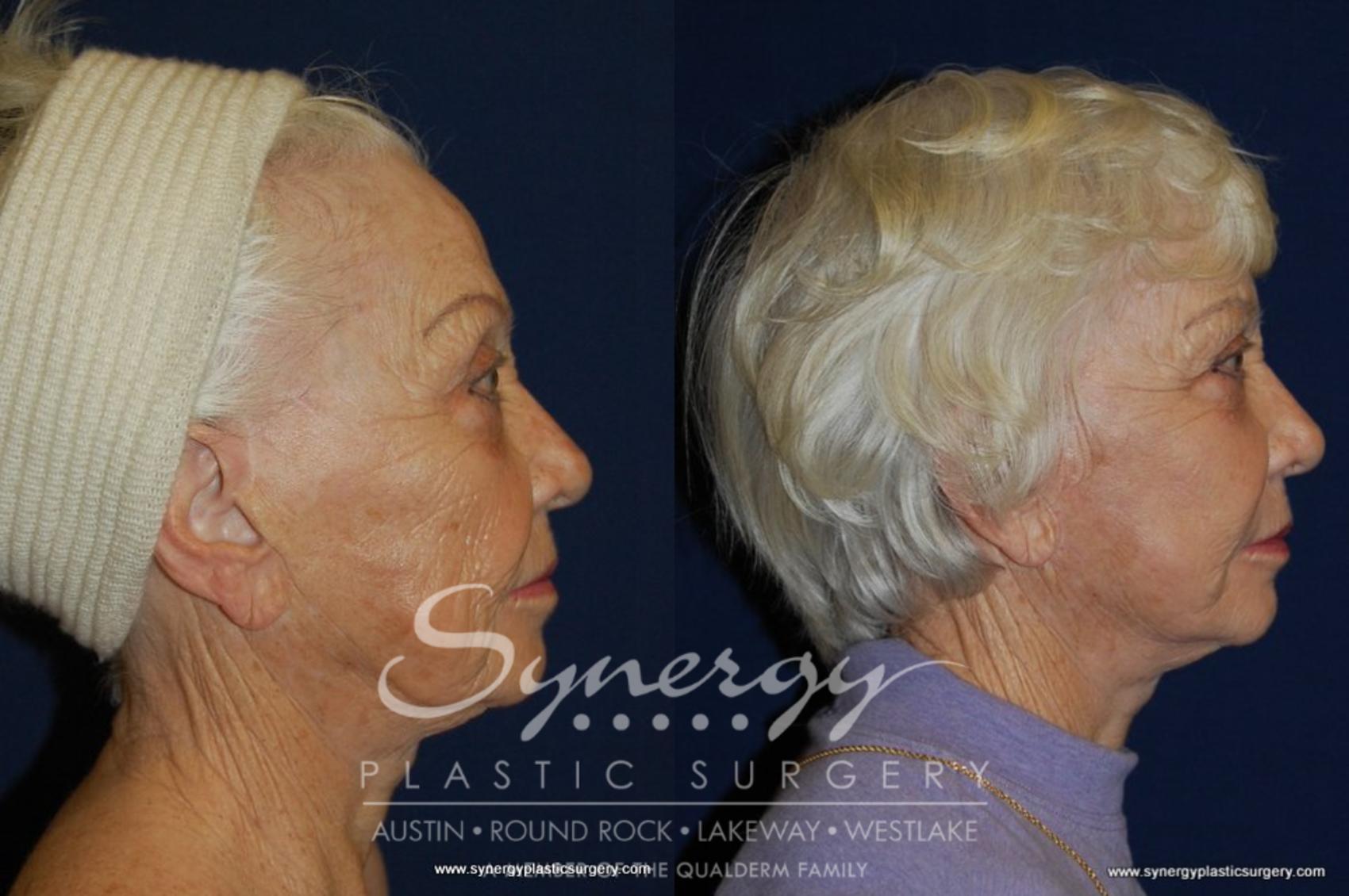 Before & After Facelift Case 199 View #3 View in Austin, TX