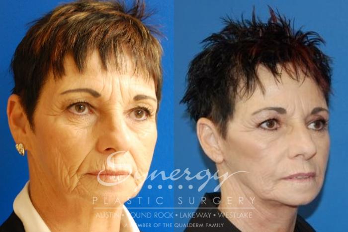 Before & After Facelift Case 26 View #5 View in Austin, TX