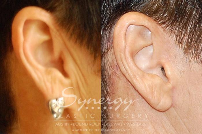 Before & After Facelift Case 26 View #8 View in Austin, TX