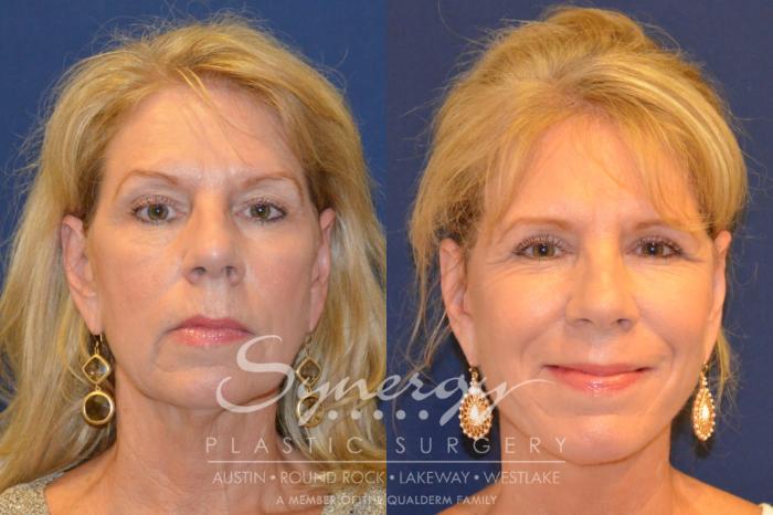 Before & After  Case 296 View #1 View in Austin, TX