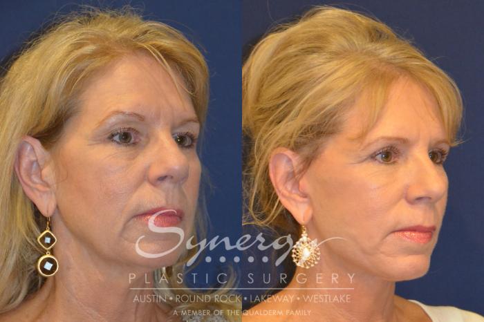 Before & After  Case 296 View #3 View in Austin, TX