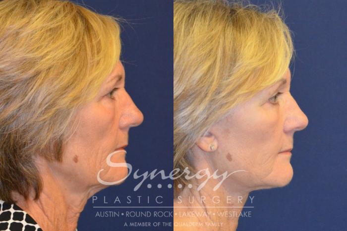 Before & After Facelift Case 367 View #2 View in Austin, TX