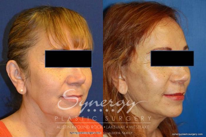 Before & After Facelift Case 371 View #3 View in Austin, TX