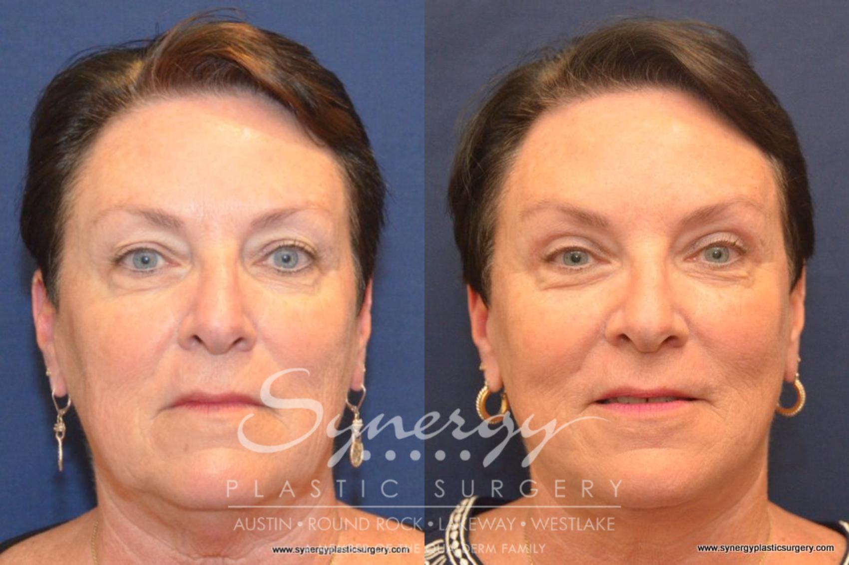 Before & After Facelift Case 406 View #1 View in Austin, TX