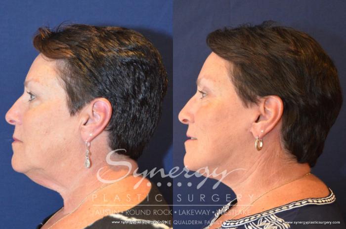 Before & After  Case 406 View #2 View in Austin, TX