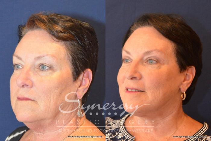 Before & After  Case 406 View #3 View in Austin, TX