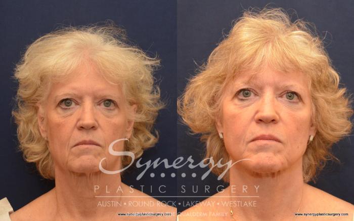 Before & After Facelift Case 498 View #1 View in Austin, TX