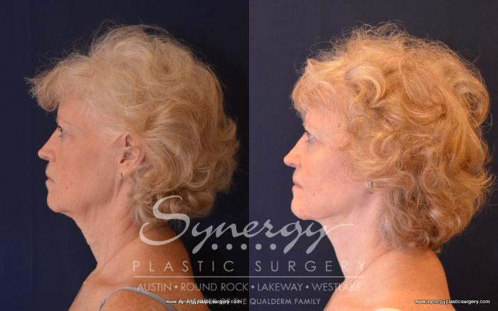 Before & After  Case 498 View #4 View in Austin, TX