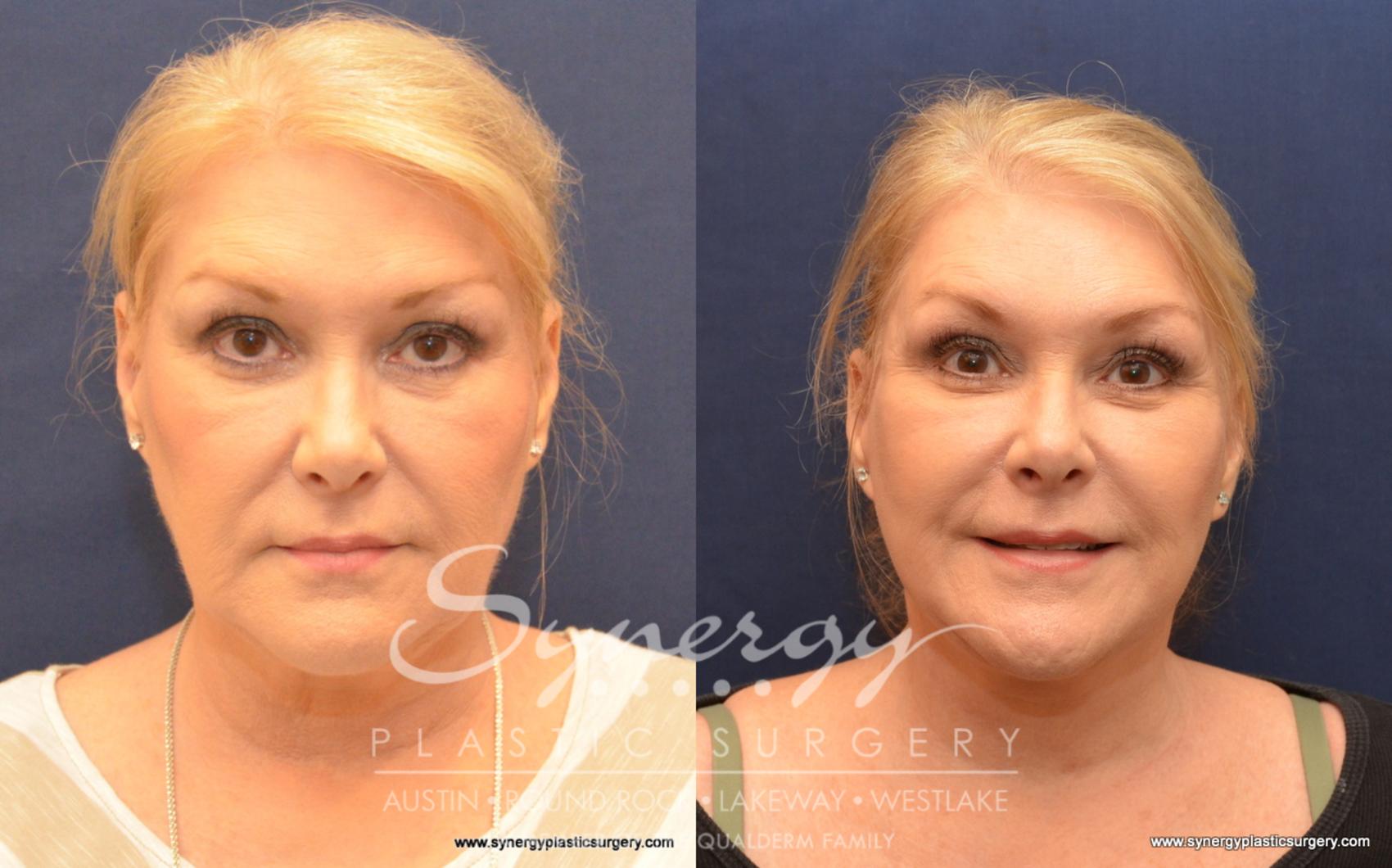 Before & After Facelift Case 526 View #1 View in Austin, TX