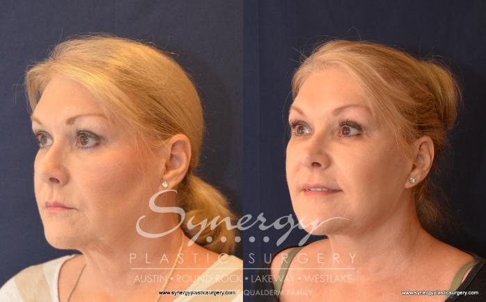 Before & After Facelift Case 526 View #2 View in Austin, TX