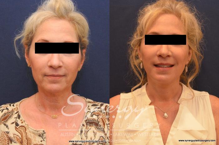 Before & After Facelift Case 566 View #1 View in Austin, TX