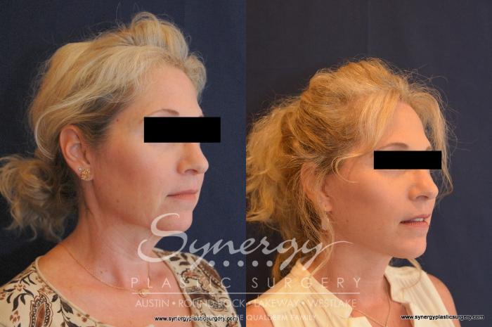 Before & After Facelift Case 566 View #2 View in Austin, TX