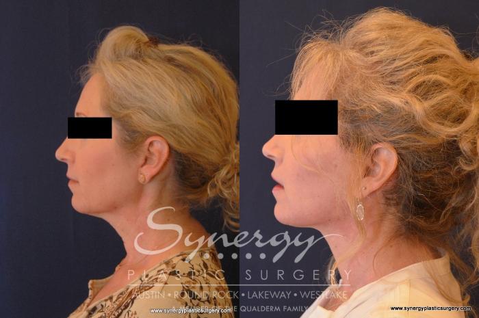 Before & After Facelift Case 566 View #5 View in Austin, TX