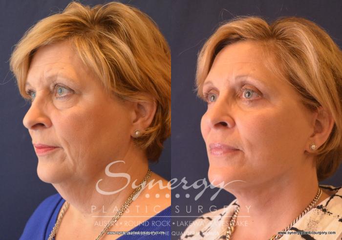 Before & After Facelift Case 658 View #2 View in Austin, TX