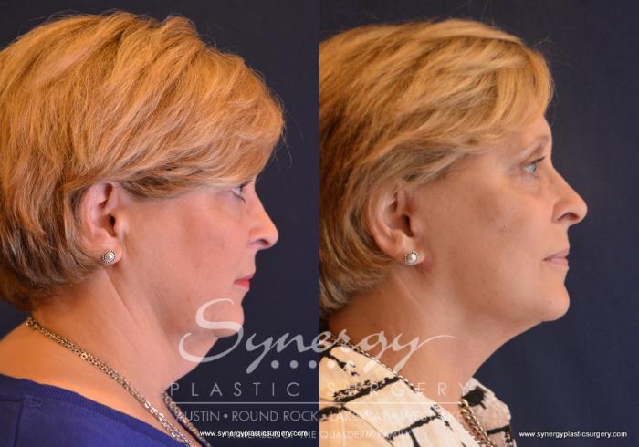 Before & After Facelift Case 658 View #4 View in Austin, TX
