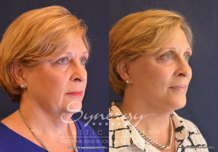 Before & After Facelift Case 658 View #5 View in Austin, TX
