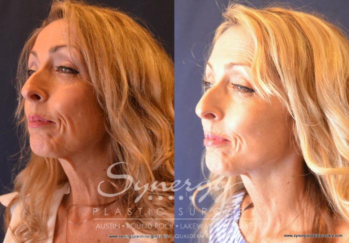 Before & After Facelift Case 680 View #1 View in Austin, TX