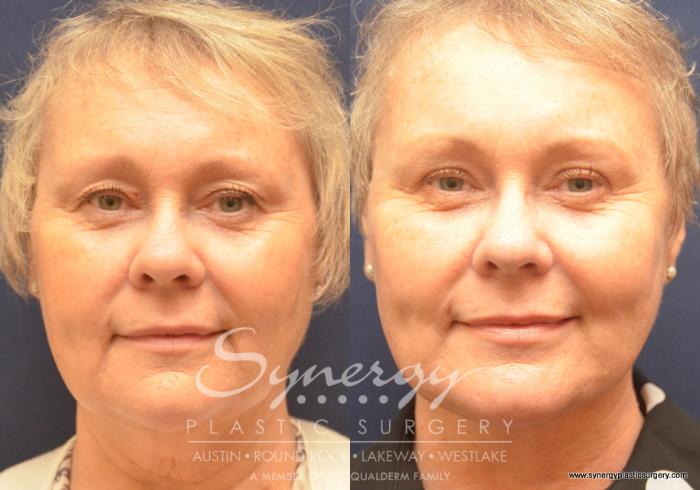 Before & After Facelift Case 688 View #1 View in Austin, TX