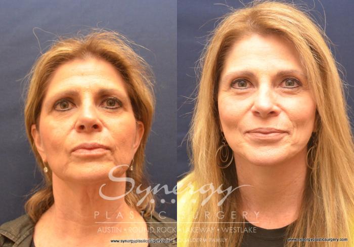 Before & After Facelift Case 743 View #1 View in Austin, TX