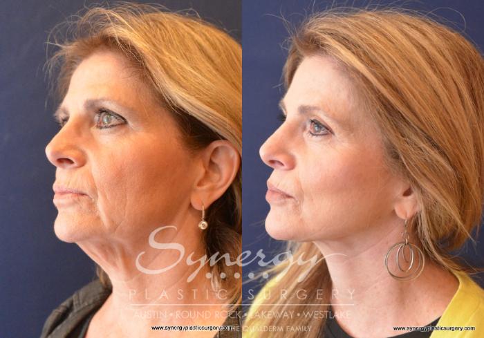 Before & After  Case 743 View #4 View in Austin, TX