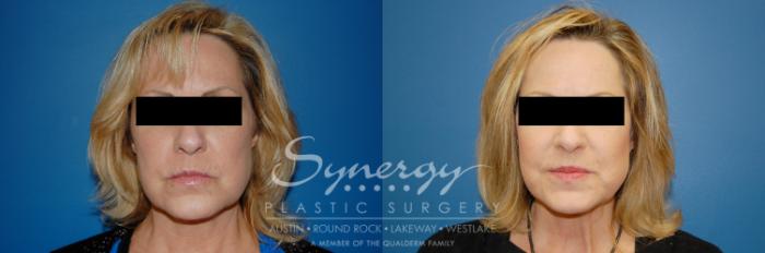 Before & After Facelift Case 9 View #1 View in Austin, TX