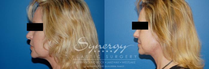 Before & After Facelift Case 9 View #4 View in Austin, TX
