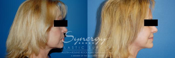 Before & After Facelift Case 9 View #5 View in Austin, TX
