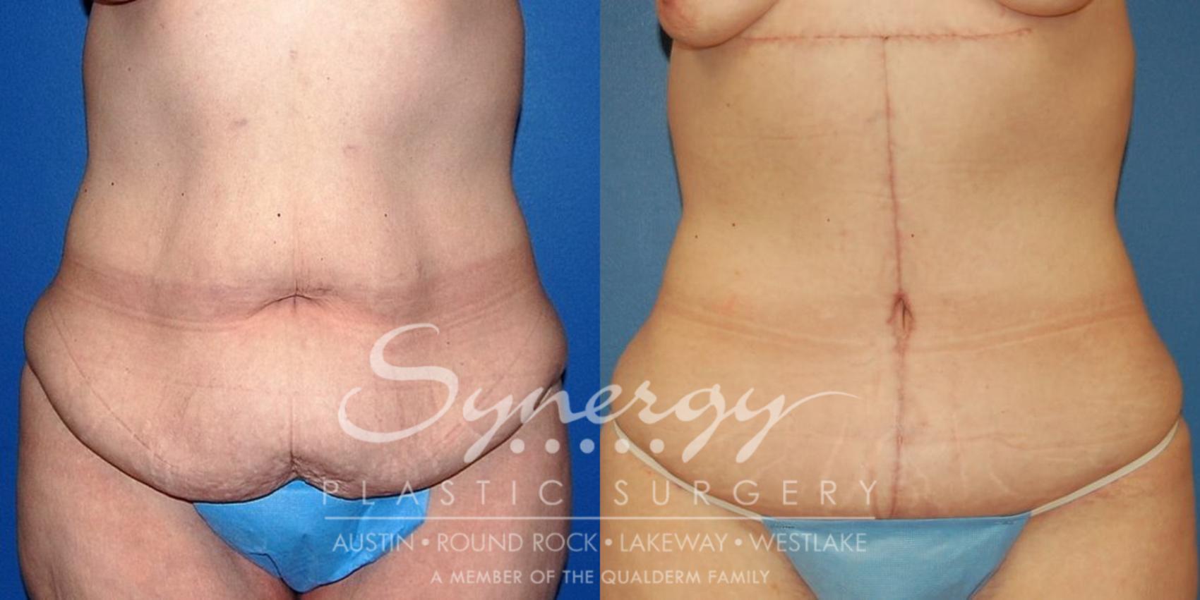 Before & After  Case 23 View #1 View in Austin, TX