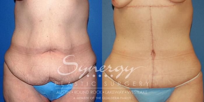 Before & After  Case 23 View #1 View in Austin, TX