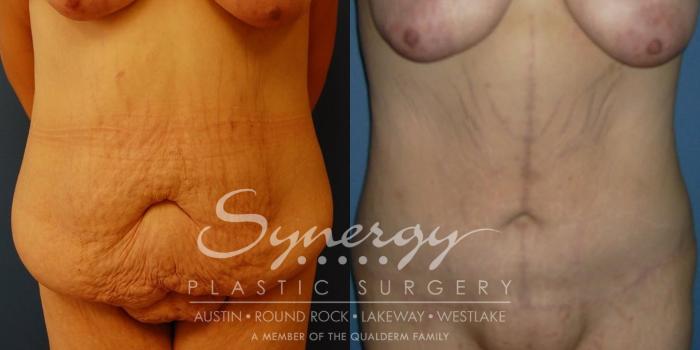 Before & After Fleur-de-Lis Tummy Tuck Case 30 View #1 View in Austin, TX