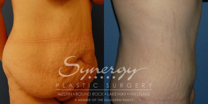 Before & After  Case 30 View #2 View in Austin, TX