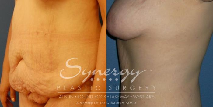 Before & After  Case 30 View #3 View in Austin, TX