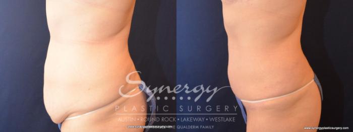 Before & After Fleur-de-Lis Tummy Tuck Case 570 View #2 View in Austin, TX