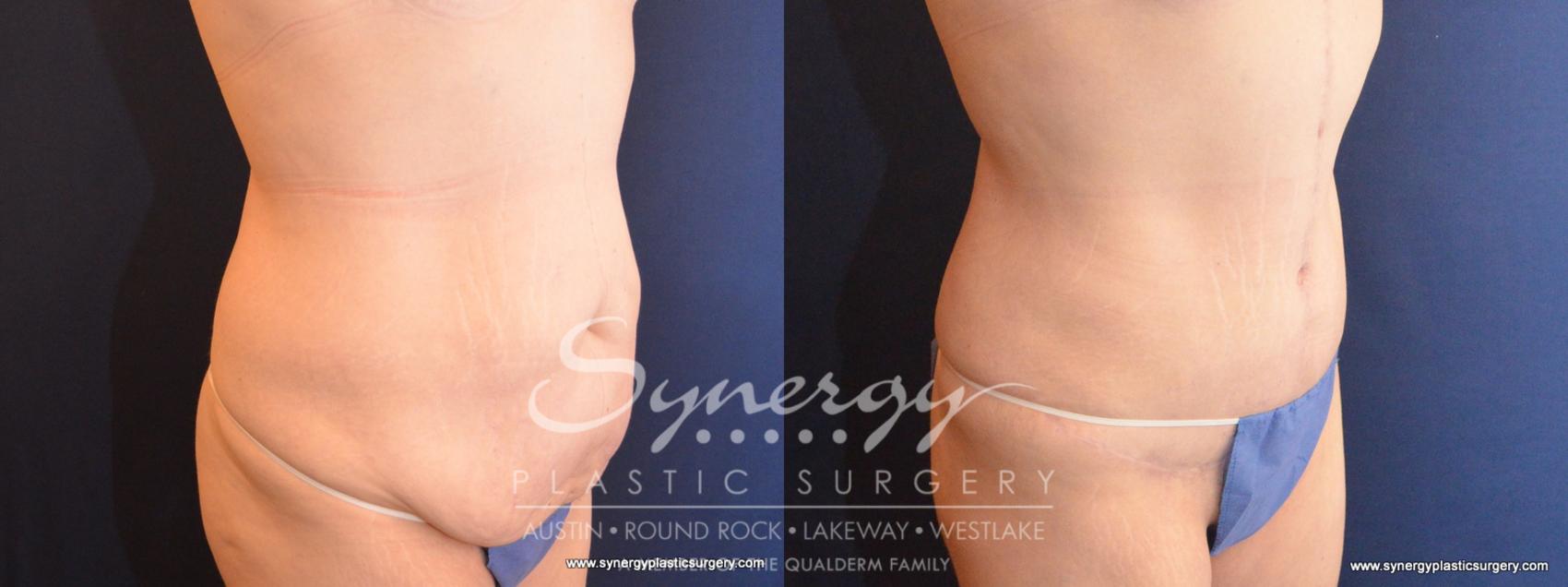 Before & After Fleur-de-Lis Tummy Tuck Case 570 View #3 View in Austin, TX