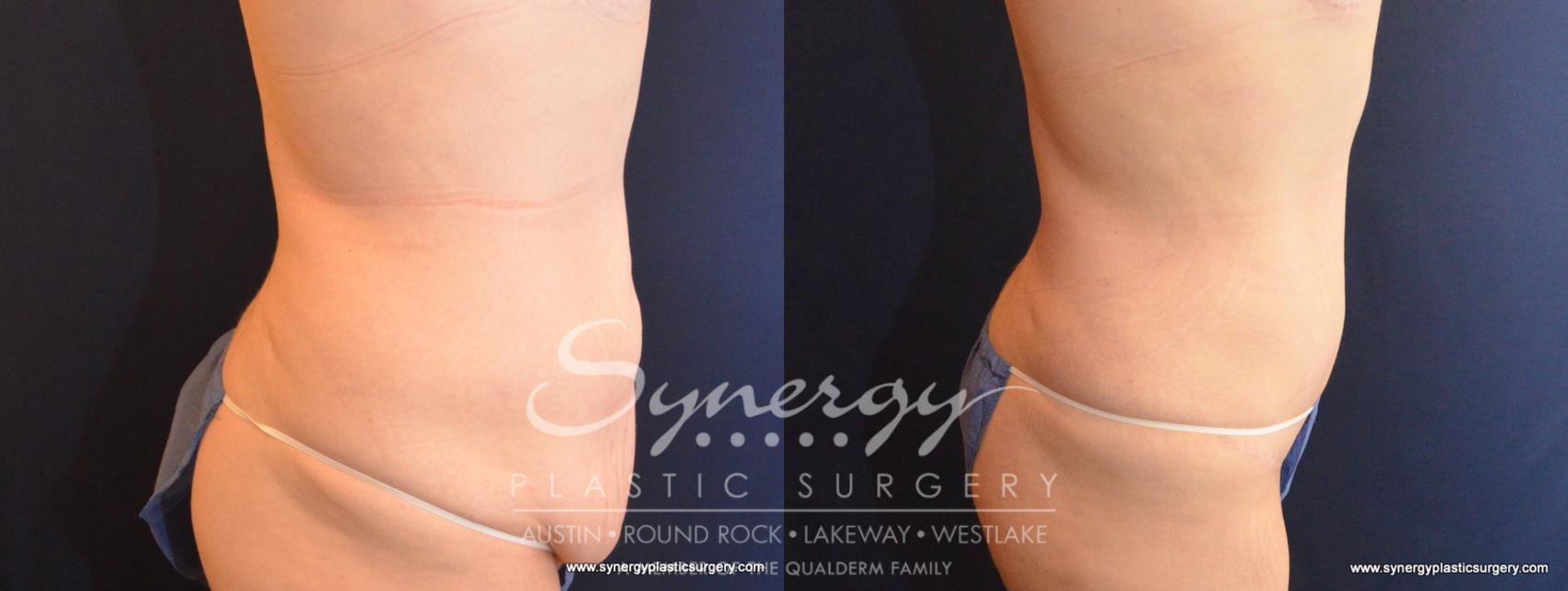Before & After Fleur-de-Lis Tummy Tuck Case 570 View #4 View in Austin, TX