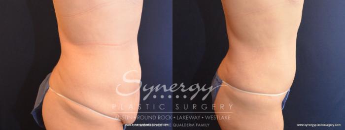 Before & After Fleur-de-Lis Tummy Tuck Case 570 View #4 View in Austin, TX