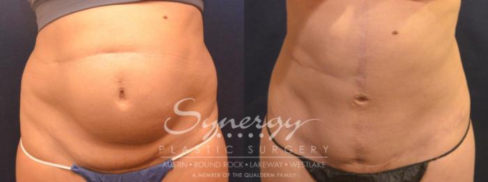 Fleur Di Lis Tummy Tuck