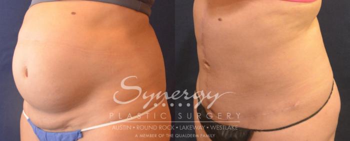 Fleur Di Lis Tummy Tuck