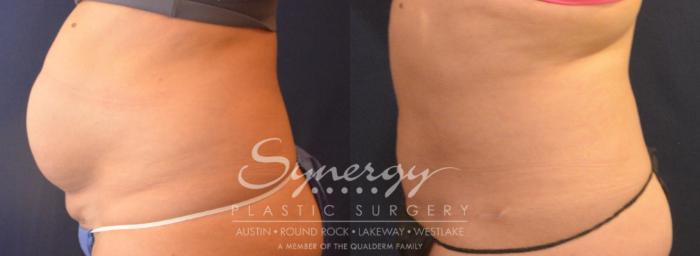 Fleur Di Lis Tummy Tuck