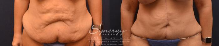 Before & After Fleur-de-Lis Tummy Tuck Case 827 Front View in Austin, TX