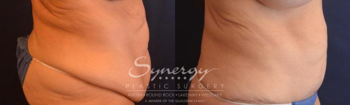 Fleur Di Lis Tummy Tuck