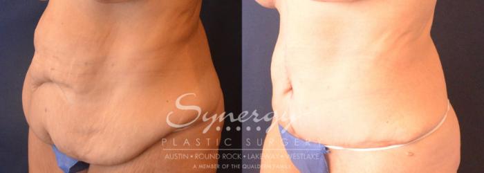 Fleur Di Lis Tummy Tuck
